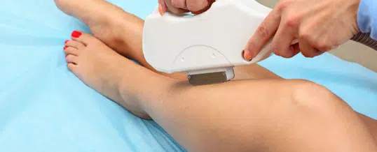 laser epilation en action