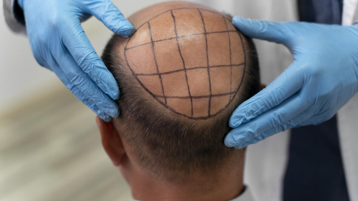 La greffe de cheveux peut vous aider à reprendre confiance en vous